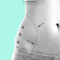 لیپو وابدو فرم دهی شکم و پهلو توسط متخصص با تخفیف