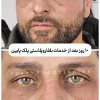 عمل بینی ابدو ساکشن اسلیو لیفت شقیقه وام|خدمات آرایشگری و زیبایی|آمل, |دیوار