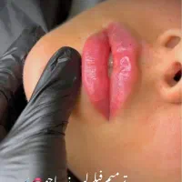 تزریـق فیلرلب چانـه زاویـه لیـفت شـقیقه