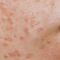 درمان 14 روزه HPV و زگیل