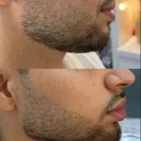 جشنواره تخفیف فیلر بوتاکس|خدمات آرایشگری و زیبایی|اهواز, کیانپارس |دیوار