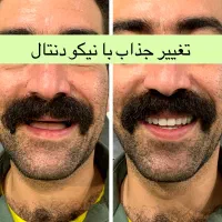 دندان مصنوعی طرح لمینیت