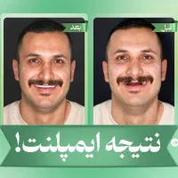 مرکز تخصصی ایمپلنت دیجیتال/اقساط/یکروزه/کاشت دندان|خدمات آرایشگری و زیبایی|تهران, پاسداران|دیوار