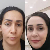 آفر۵۰ درصدی تزریق ژل و بوتاکس ب مدت محدود