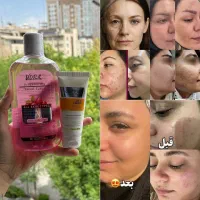 درمان لک ، جای جوش و چاله بودن صورت وچین وچروک