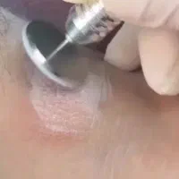 روشن سازی نقاط تیره بدن فیشال پدیکور کراتین پروتز