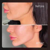 جشنواره تخفیفی ژل و بوتاکس/وام/اقساطی|خدمات آرایشگری و زیبایی|ساری, |دیوار