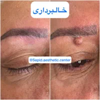 بوتاکس‌ ژل فیلر مزو خالبرداری‌ کرایو‌ وهایفو ولیزر|خدمات آرایشگری و زیبایی|تبریز, |دیوار