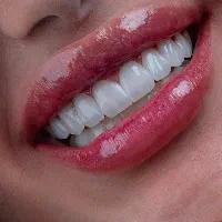 عصب کشی ، کامپوزیت اقساط،ترمیم ،پروتز، جرم گیری