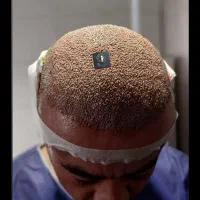 استخدام تکنسین کاشت مو و ابرو در کلینیک