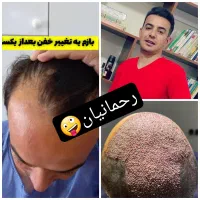 کاشت مو،ابر،ریش به روش تخصصی FiT
