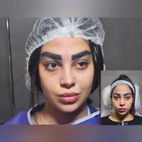 کاشت ابرو بدون جراحی و با جراحی