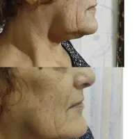 لیزر تاتو وخالکوبی ،جای جوش بخیه زخم،اندولیفت|خدمات آرایشگری و زیبایی|فولادشهر, B5|دیوار