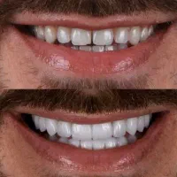 تخفیف ویژه کامپوزیت و خدمات دندانپزشکی|خدمات آرایشگری و زیبایی|اسلام‌شهر, باغ فیض|دیوار
