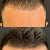 میکرو اسکالپ/مکمل کاشت/رفع کم پشتی