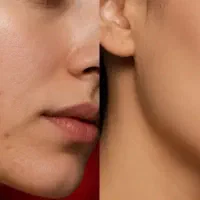 شفافیت  صورت و کنترل چربی