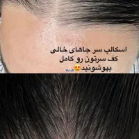 مدل برای موهای کم پشت خانم تکنیک میکرو اسکالپ