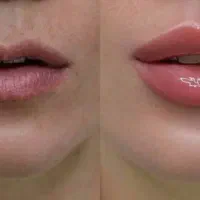 آنزم و مزو تراپی و فیلر و بوتاکس|خدمات آرایشگری و زیبایی|قرچک, مهدیه|دیوار