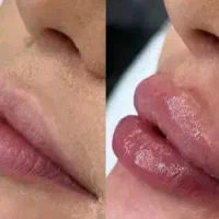 کلیه خدمات فیلر و بوتاکس