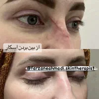 درمان کک ومک/درمان لک/درمان جوش/ردبخیه/اسکار|خدمات آرایشگری و زیبایی|قدس, شهر‌قدس|دیوار