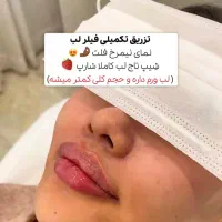 جشنواره تزریق ژل و لیفت صورت|خدمات آرایشگری و زیبایی|قم, زنبیل آباد|دیوار