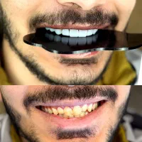 کامپوزیت دندان با طرح اقساطی الماس ، چک ، وام|خدمات آرایشگری و زیبایی|محمدیه-قزوین, |دیوار