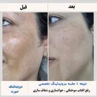 مزونیدلینگ ، PRP ، مزوتراپی صورت و مو|خدمات آرایشگری و زیبایی|دوگنبدان, |دیوار