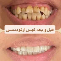 کامپوزیت دندان با تضمین ماندگاری + ویزیت رایگان