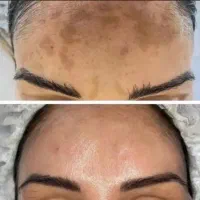 حذف تتو/پیلینگ کربن/روشن سازی پوست/رفع لک پوست