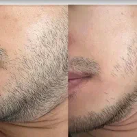 تغییر چشمگیر در ظاهر صورت (ضمانت کیفیت)|آرایشی، بهداشتی، درمانی|تهران, شوش (باغ آذری)|دیوار