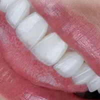 ایمپلنت با روکش سرامیکی ۱۶۵۰۰