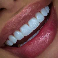 تخفیف ویژه کامپوزیت دندان به مدت یک ماه