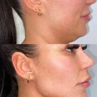 جشنواره ژل و بوتاکس و نخ در مطب پزشکی|خدمات آرایشگری و زیبایی|کرج, گلشهر|دیوار