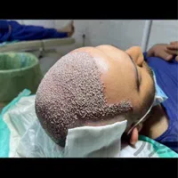 کاشت مو ، ریش ، ابرو|خدمات آرایشگری و زیبایی|شیراز, معالی‌آباد|دیوار