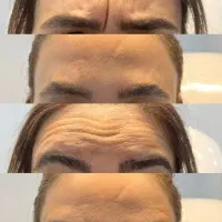 تزریق بوتاکس وژل فقط قیمت مواد|خدمات آرایشگری و زیبایی|اهواز, ۲۴ متری|دیوار