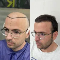 کاشت مو تیم شیراز و مشهد در یزد (تضمینی و اقساطی)|خدمات آرایشگری و زیبایی|یزد, |دیوار