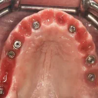 ایمپلنت با اقساط بلند مدت در تبریز|خدمات آرایشگری و زیبایی|اهر, |دیوار