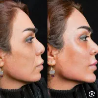 آفر ویژه آخر سال ژل . بوتاکس . مزو.فول فیس .زاویه