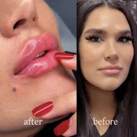 تزریق ژل بوتاکس وانزیم فیلر بینی ۳۹۹