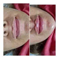 ژل/بوتاکس/فیلرلب هایفو/نخ/جوانسازتوسط پزشک کلینیک|خدمات زیبایی و سلامت|رشت, گلسار|دیوار