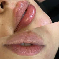 تزریق ژل و بوتاکس تخفیف