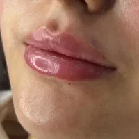 فیلر و بوتاکس جشنواره پاییزه افر روی خدمات زیبایی|خدمات آرایشگری و زیبایی|کرمانشاه, |دیوار