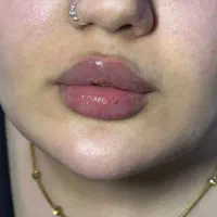 تزریق فیلر و بوتاکس اقساط توسط پزشک در مطب|خدمات آرایشگری و زیبایی|خرمشهر, |دیوار