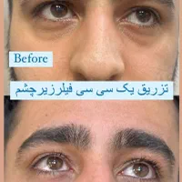 تزریق فیلر و بوتاکس|خدمات آرایشگری و زیبایی|اهواز, گلستان|دیوار