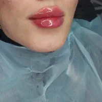 تزریق ژل|خدمات آرایشگری و زیبایی|زنجان, |دیوار
