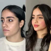 انجام ژل ،نخ ،چربی، پی ار پی،مزو