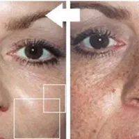 فروش مواد زگیل تناسلی تضمینی با ی بار استفاده|خدمات آرایشگری و زیبایی|یاسوج, |دیوار