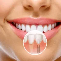 جشنواره اثتثنایی ایمپلنت|خدمات آرایشگری و زیبایی|شیراز, خلدبرین|دیوار