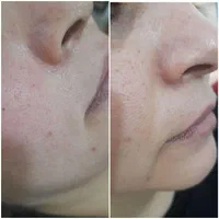 انجام کلیه خدمات پاکسازی پوست بصورت کاملا تخصصی|خدمات آرایشگری و زیبایی|سرپل ذهاب, |دیوار