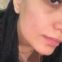 درمان جوش با هر منشایی|خدمات آرایشگری و زیبایی|دوگنبدان, |دیوار